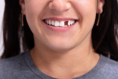 What should I do if my tooth breaks?