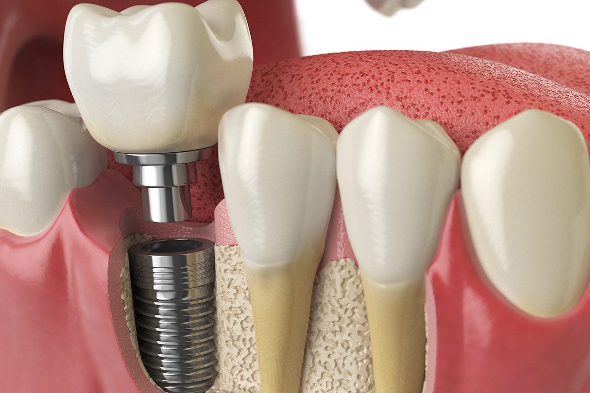 Dental implant