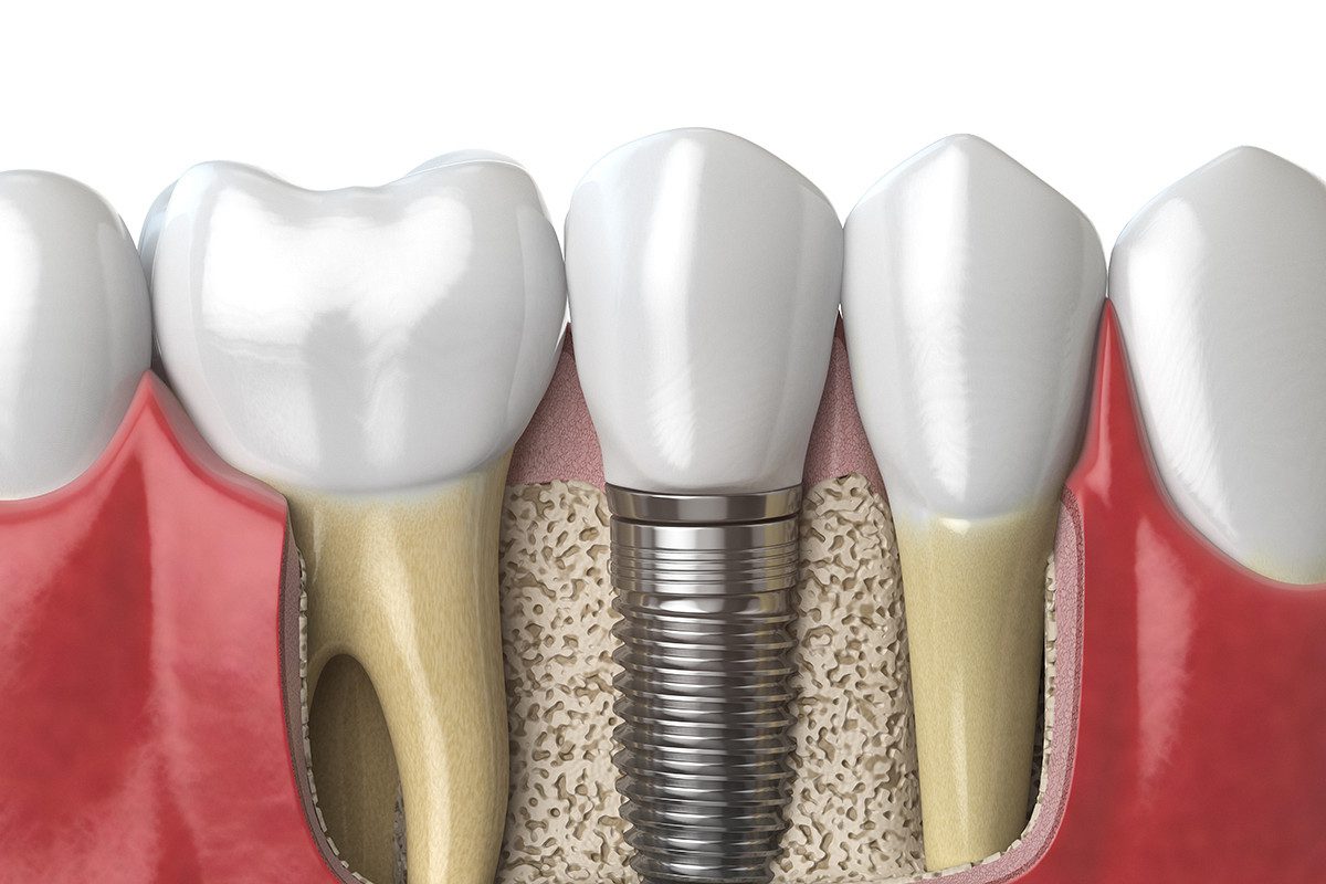 Advantage of dental implant
