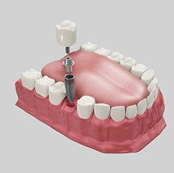 dental implant process- Eurodent