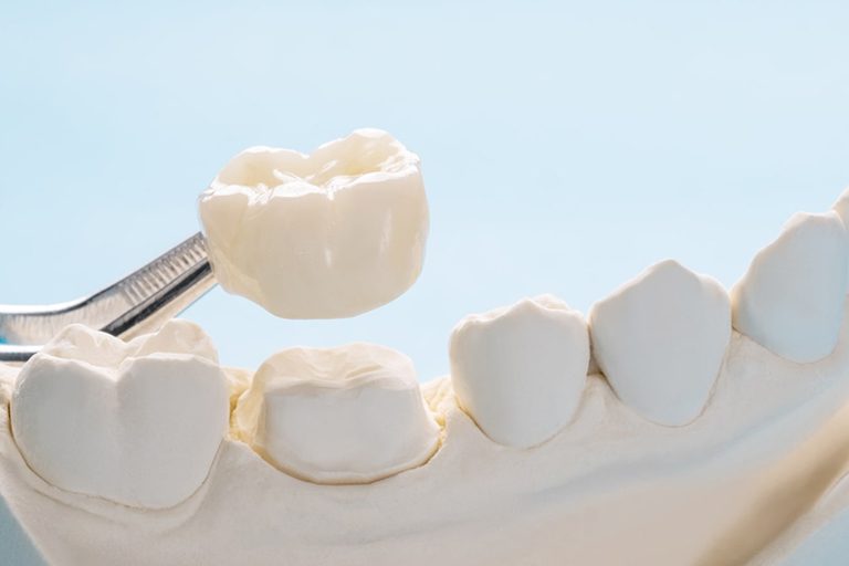 Maintain Dental Crown