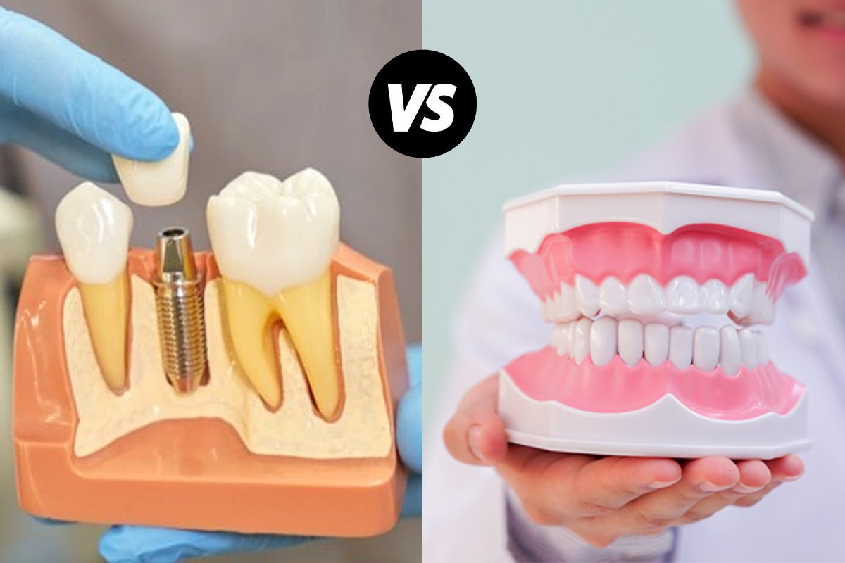 Dental Implant Vs Dental denture