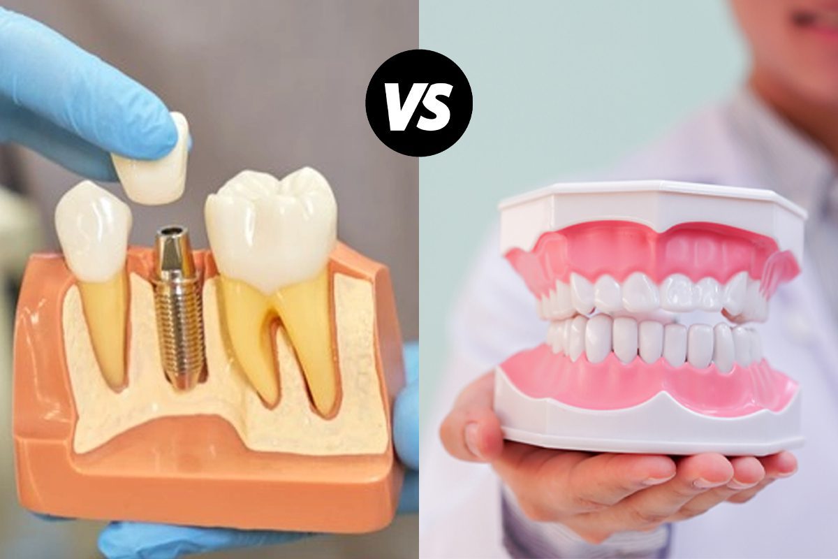 Dental Implant Vs Dentures Which One Is For You Eurodent Belgium