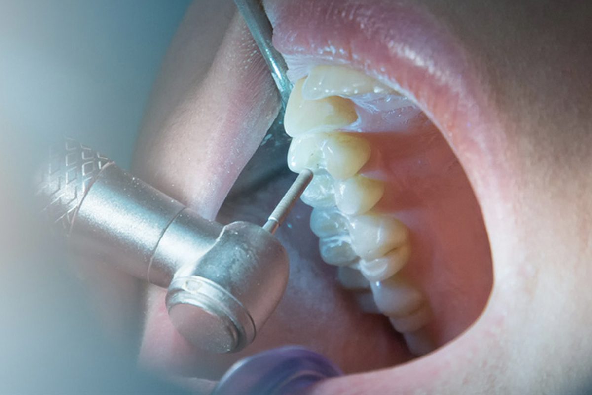 Endodontische - Behandeling, Types, en procedure