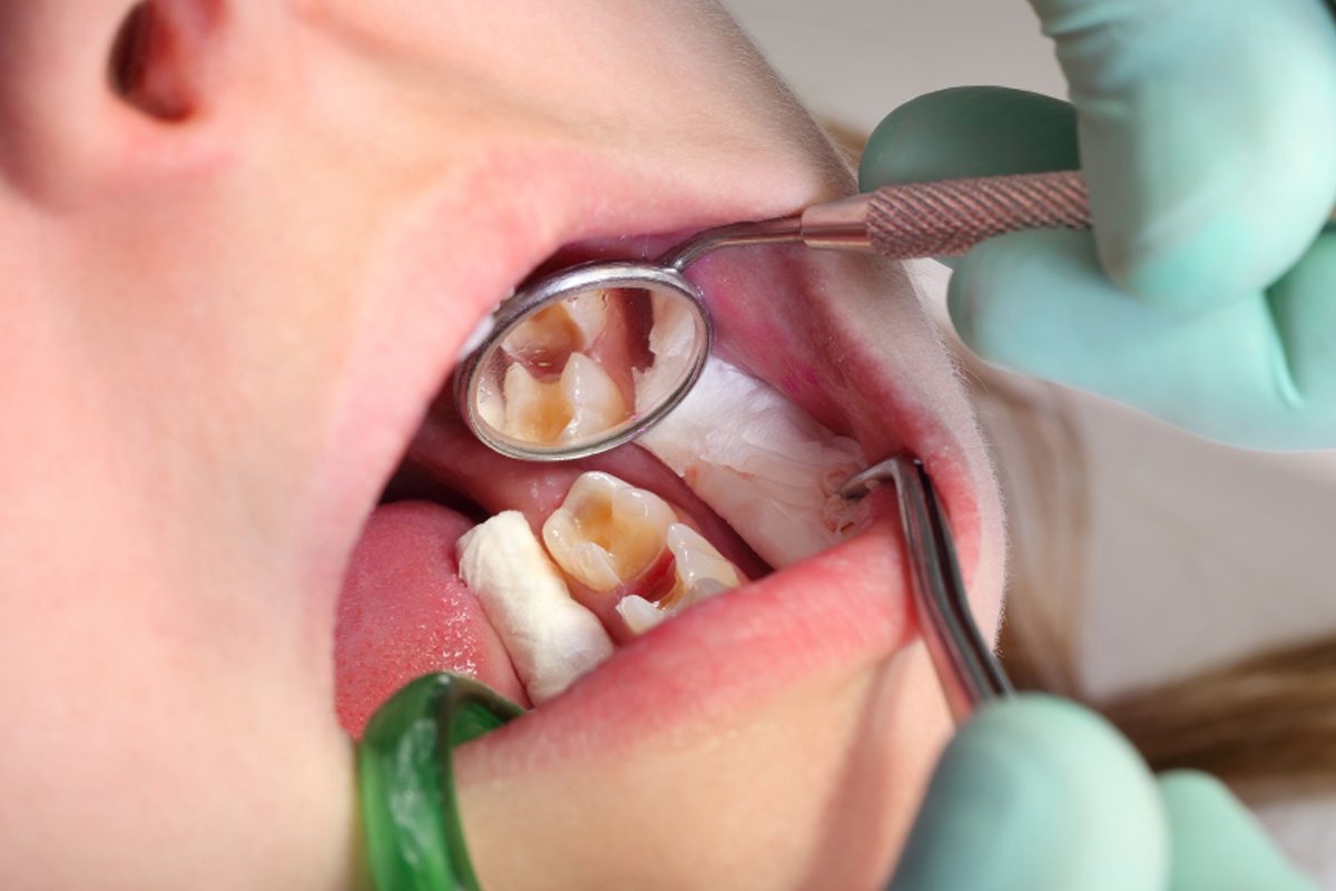 Tooth Decay Cause, Prevention, Treatment and Recovery - Euro-Dent Belgium
