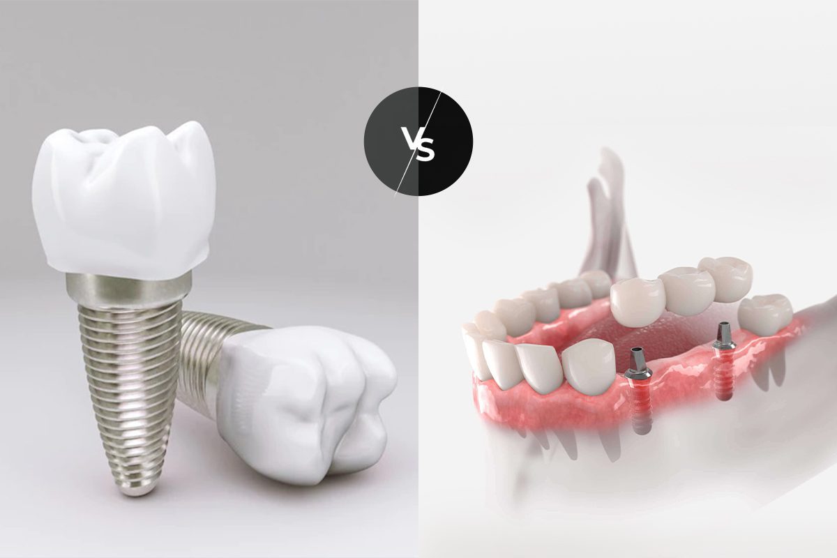 Dental Implants vs dental bridges