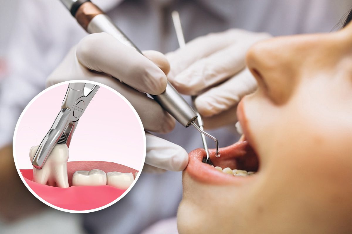 Things You Should Know About Wisdom Tooth Extraction