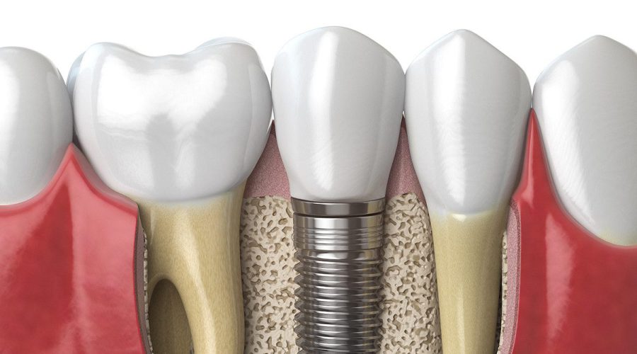 Advantage of dental implant