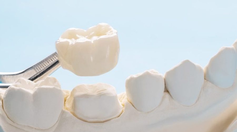 Maintain Dental Crown