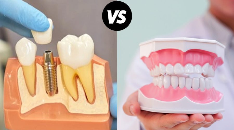 Dental Implant Vs Dental denture