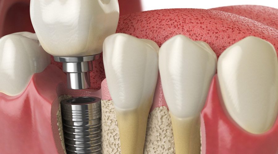 Dental implant