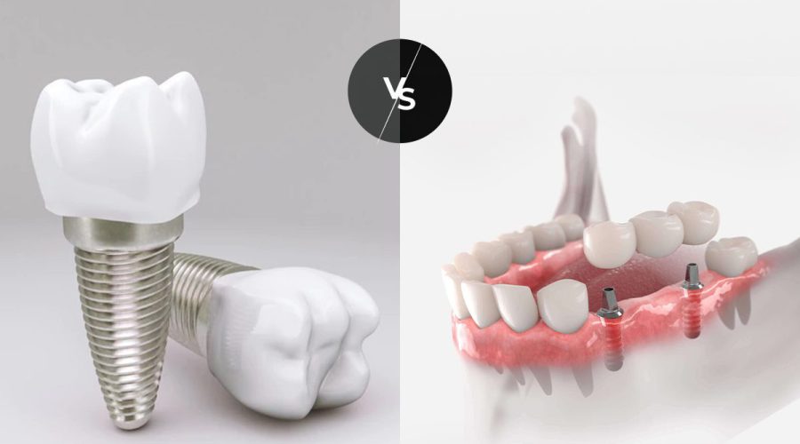 Dental Implants vs dental bridges