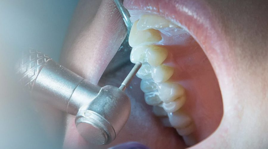 Endodontische - Behandeling, Types, en procedure