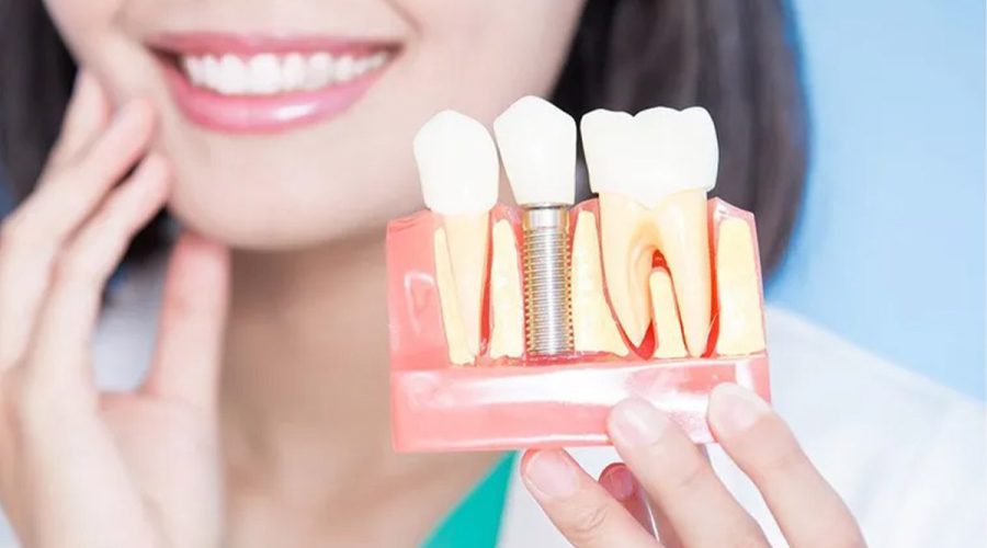 Front Tooth Implant : Everything You Need To Know