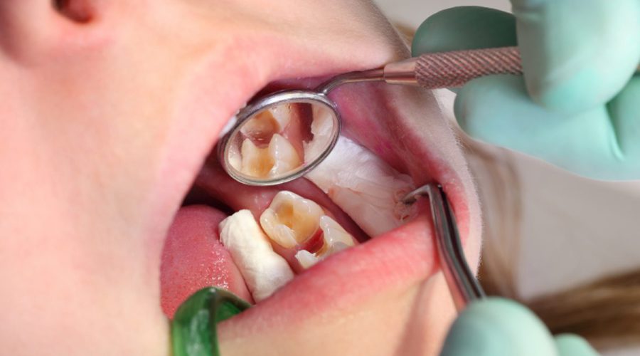 Tooth Decay Cause, Prevention, Treatment and Recovery - Euro-Dent Belgium