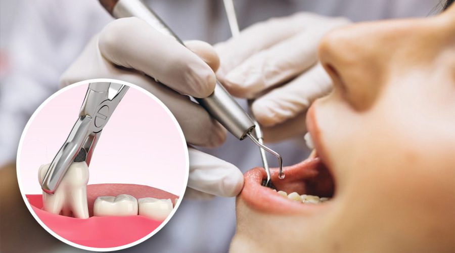 Things You Should Know About Wisdom Tooth Extraction