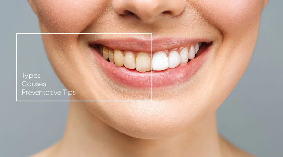 Tooth Discoloration Types Causes Preventative Tips How to Remove Stains