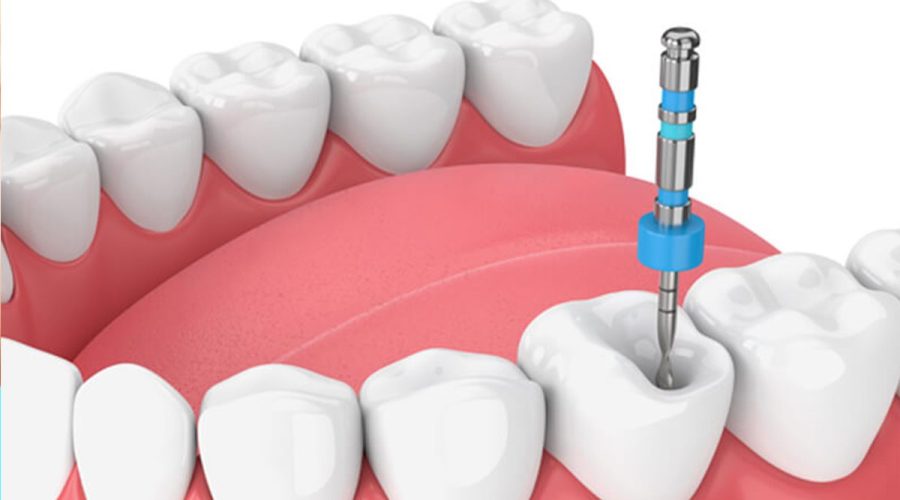 root canal treatment